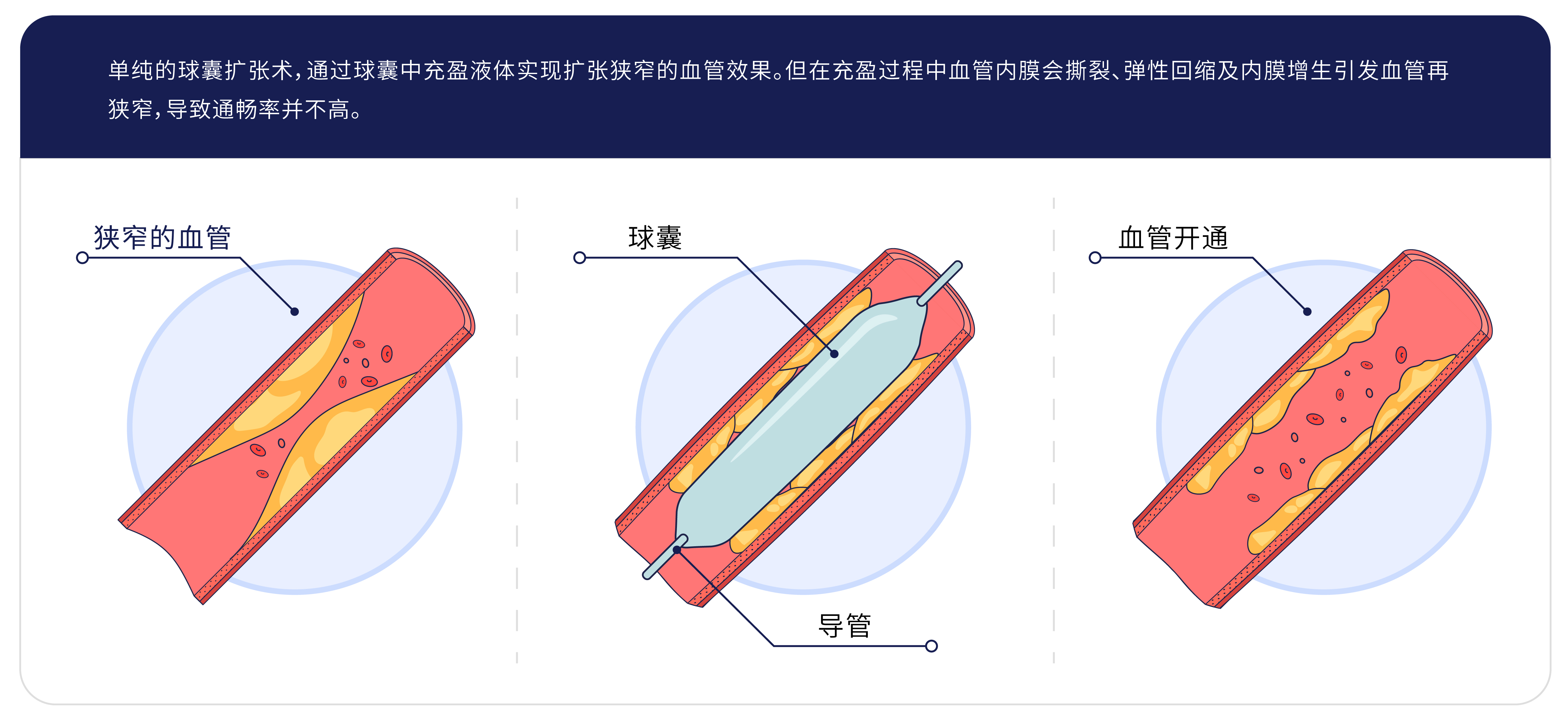 Balloon Dilatation