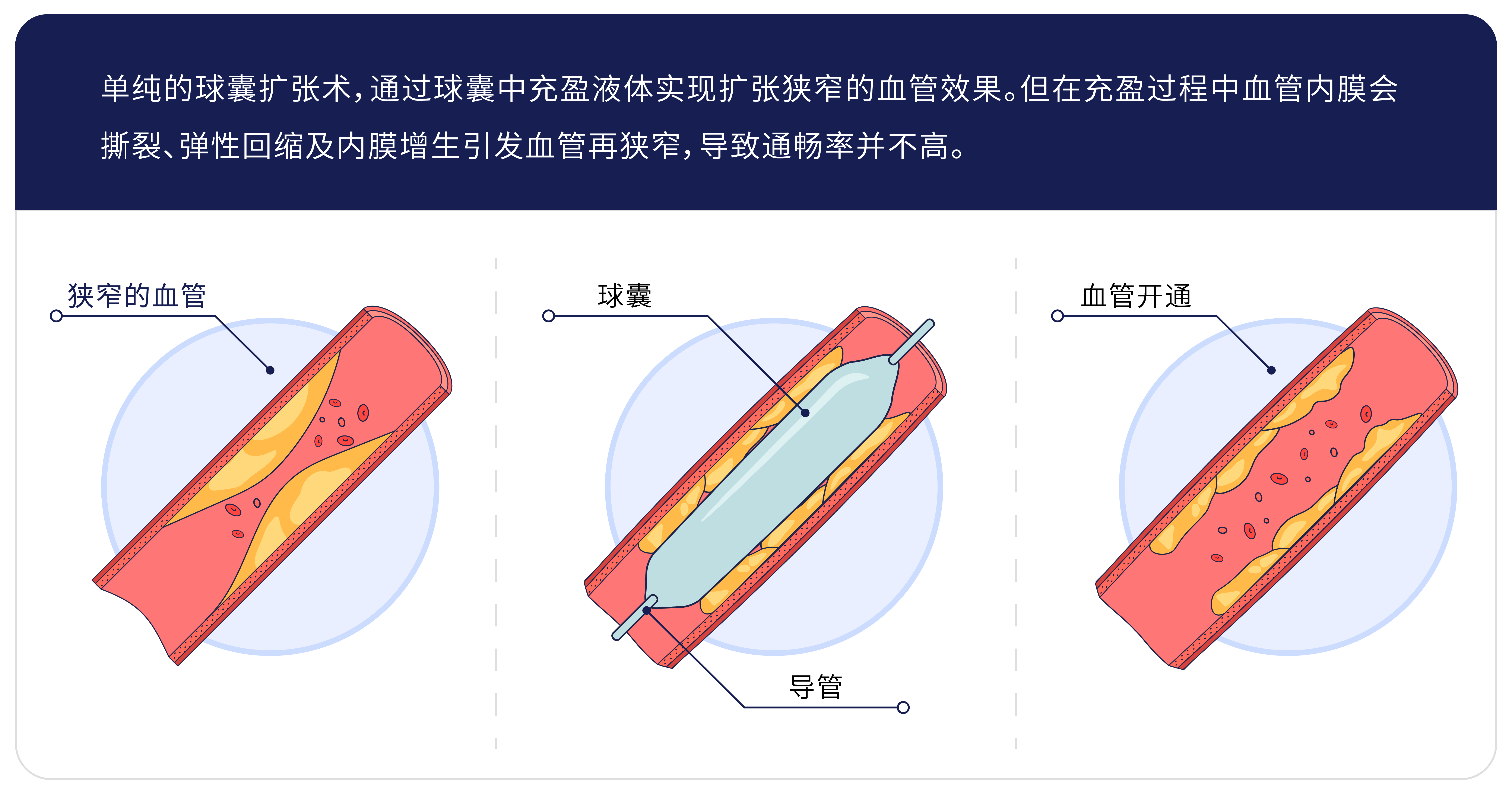 球囊扩张术.jpg